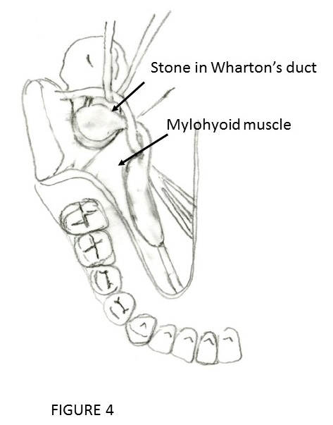 whartons duct stone