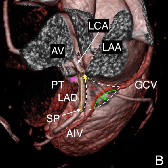 Left ventricular summit -- concept, anatomical description and