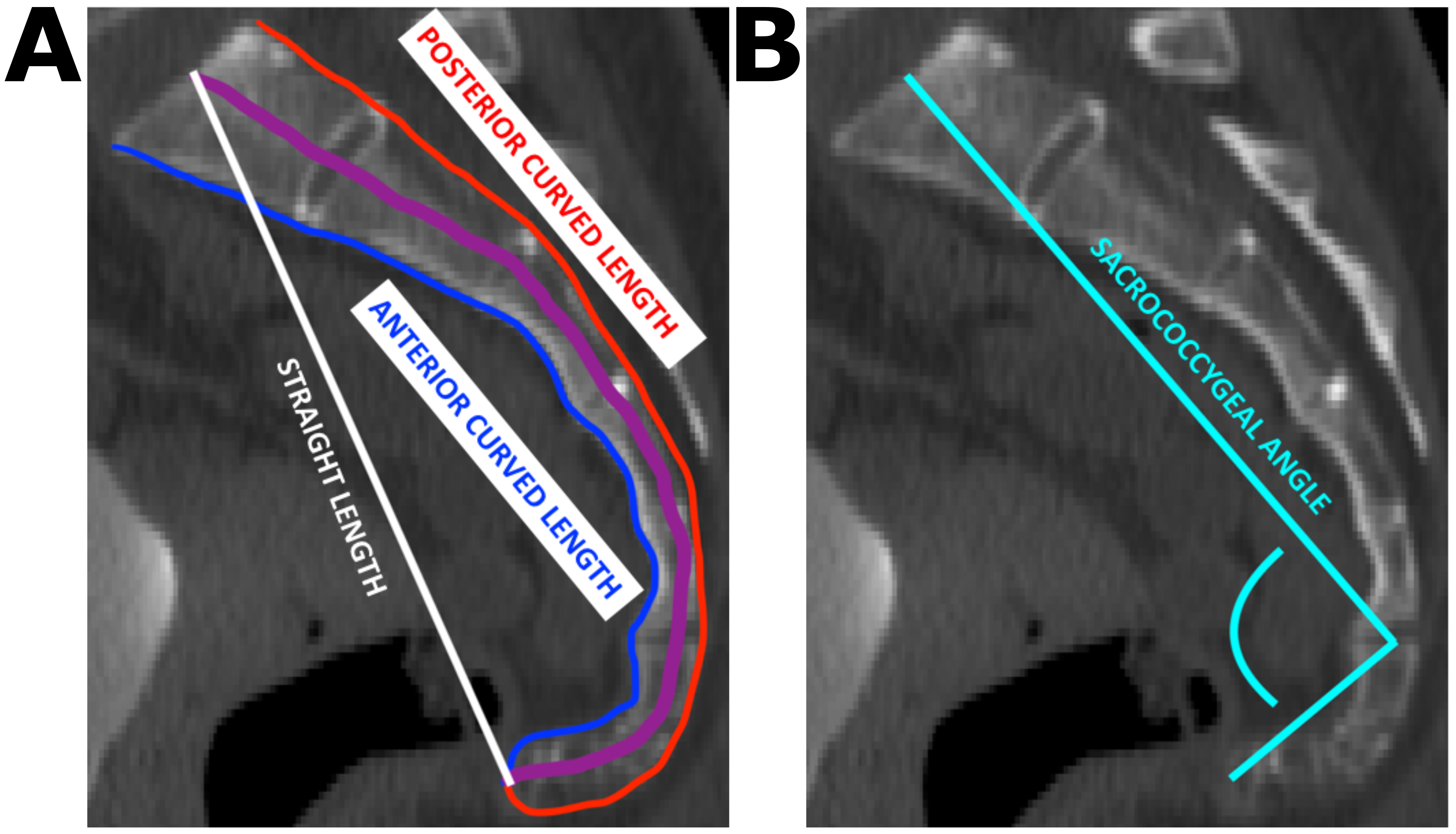 Shape Changes in Midsagittal Sacrum and Coccyx Shape During Pregnancy