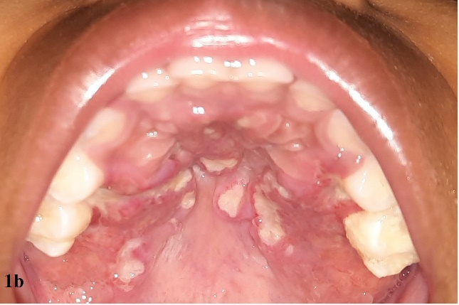 langerhans cell histiocytosis jaw