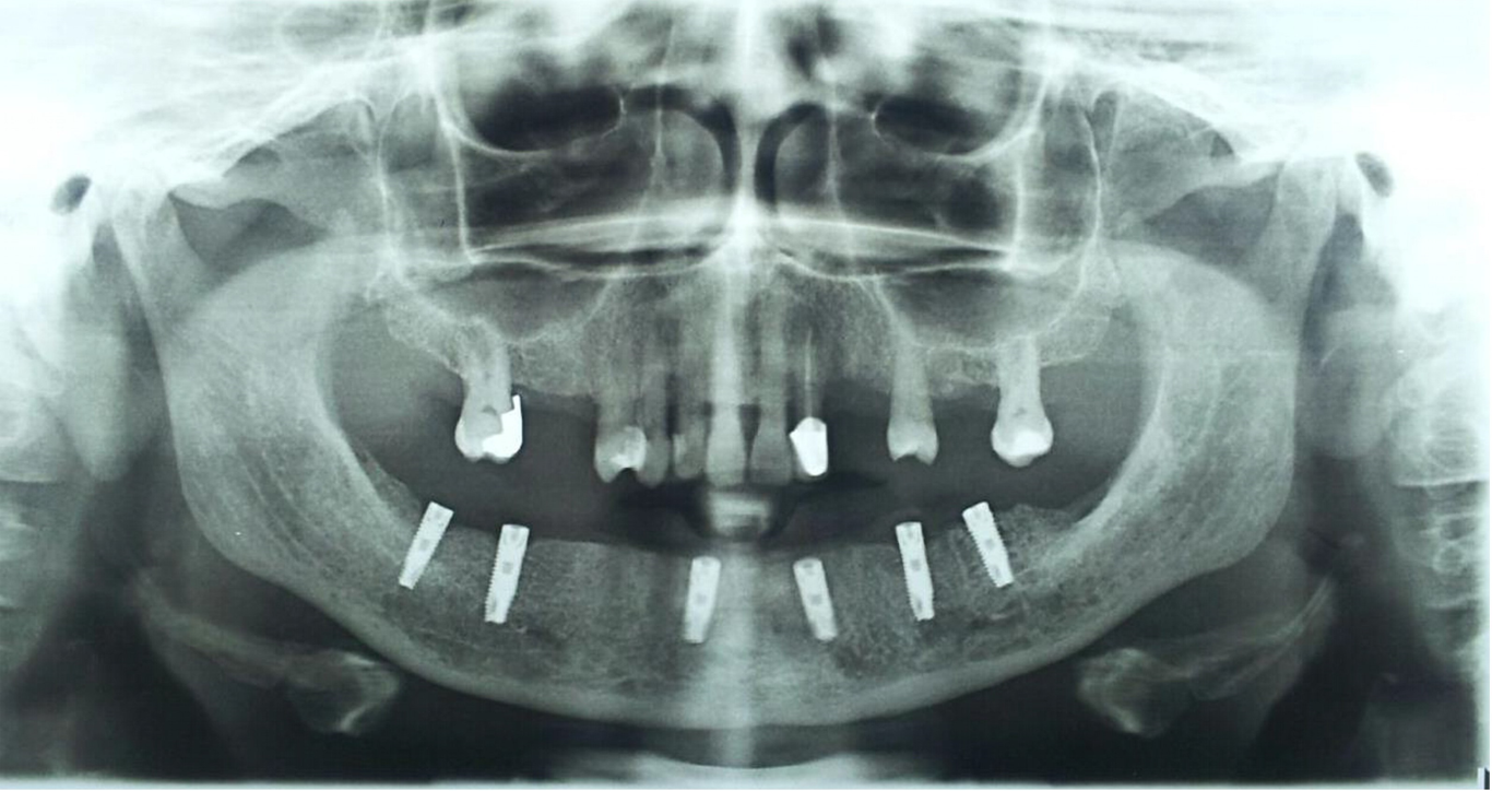 Maxillary cast partial denture and mandibular implant-supported ...